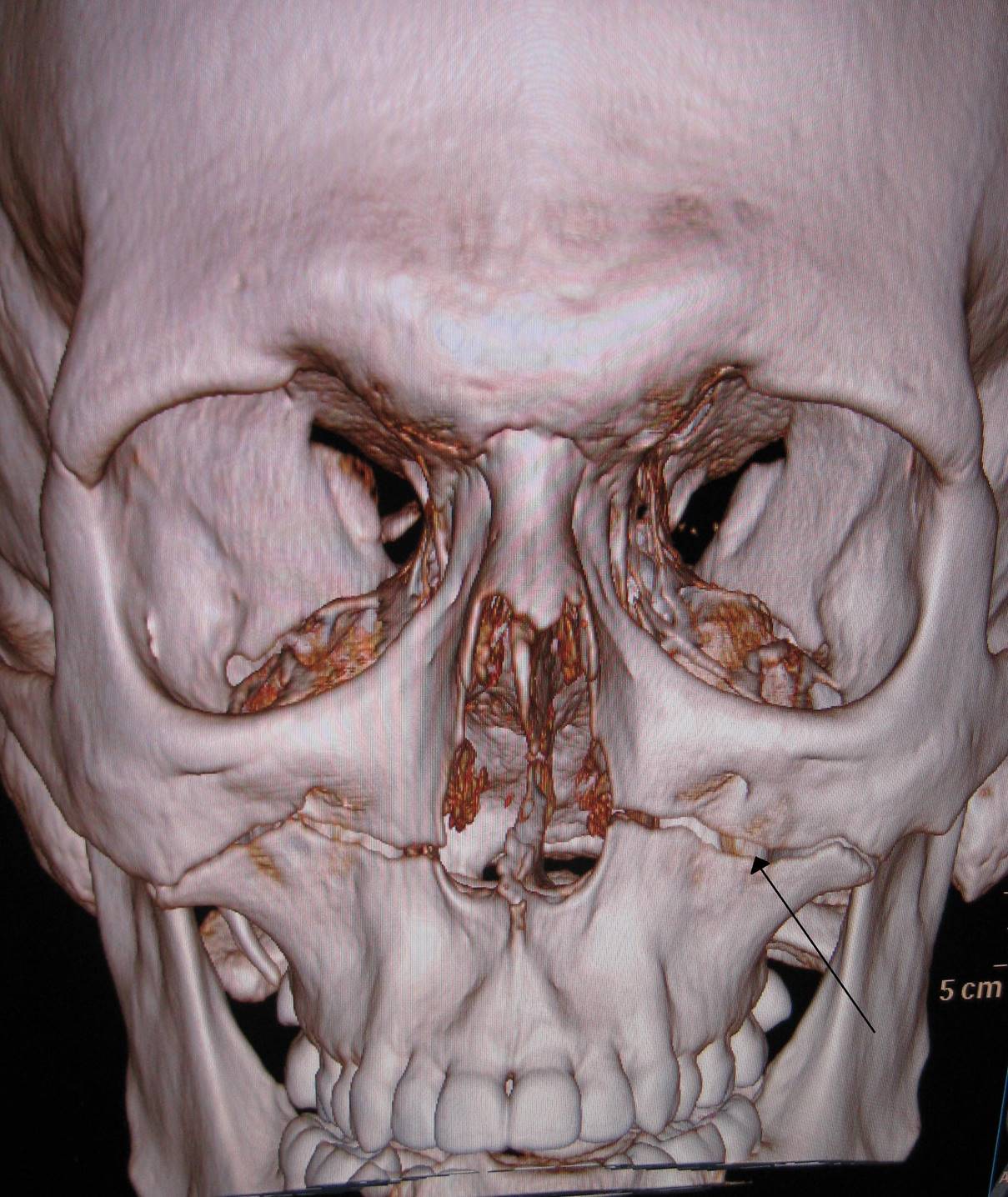 Image result for marked skull